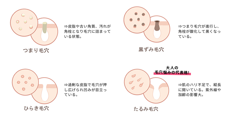 毛穴の種類