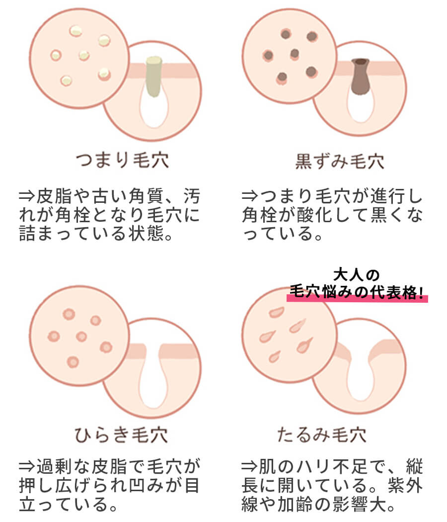 毛穴の種類